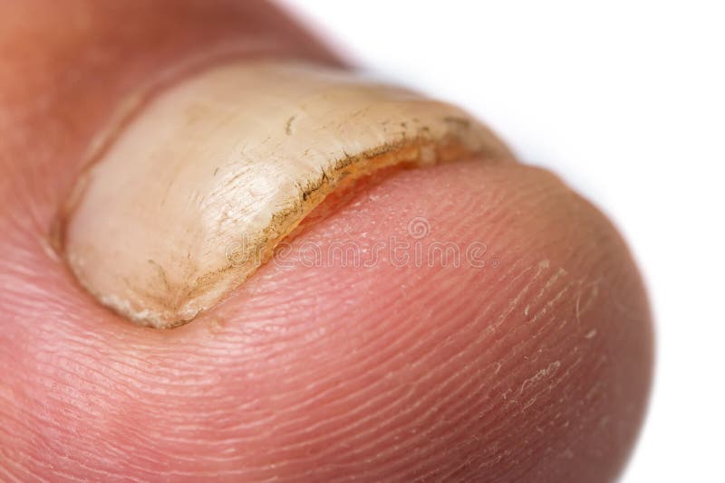 Toe Nail with Psoriasis and Healthy Toe Nails, Psoriatic Nail, Closeup