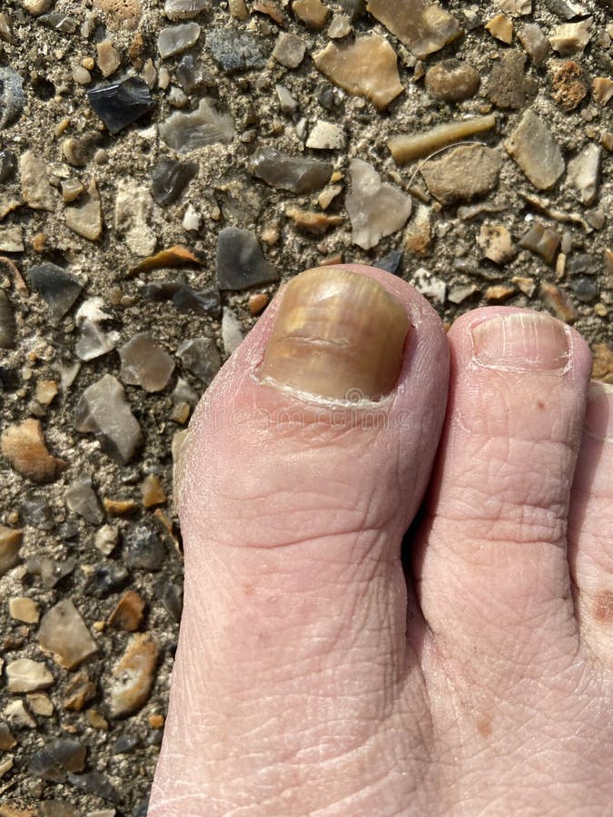 https://thumbs.dreamstime.com/b/toenail-care-nail-fungus-thickened-big-toe-nail-person-suffering-onychomycosis-fungal-infection-causing-yellow-237163675.jpg