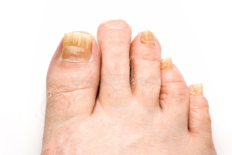 Toenail Fungus stock photo. Image of toenails, fungus 11278012