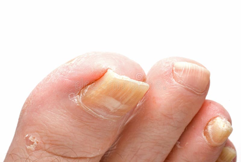 Toenail Fungus