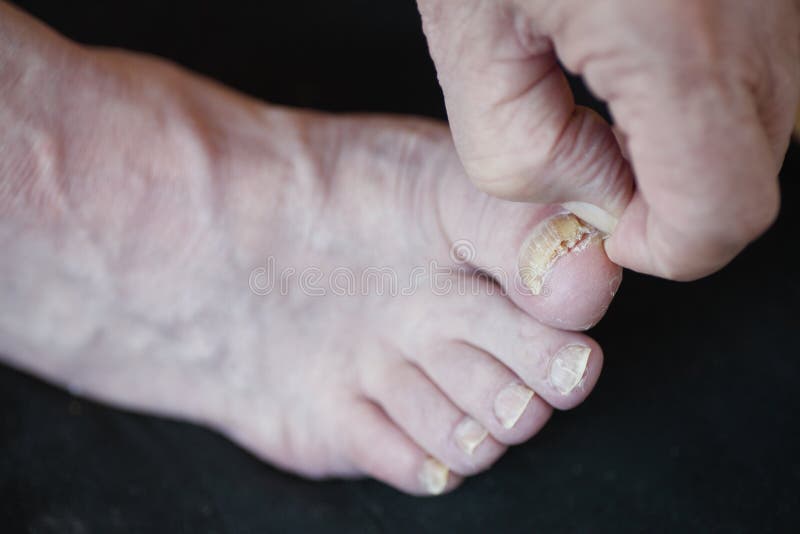 gombák foot nail treatment)