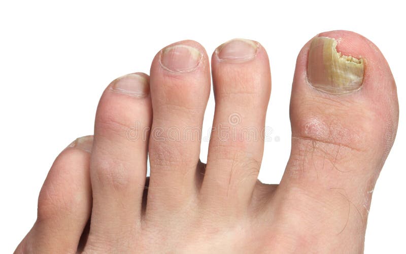 Toenail Fungus at Peak Infection