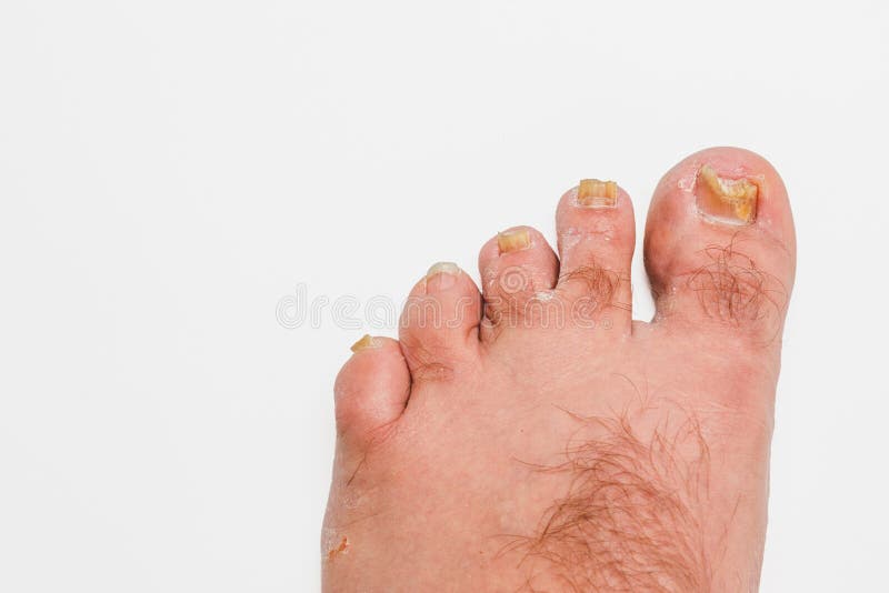 Cukorbetegek speciális lábápolószerei - Foot cukorbetegség