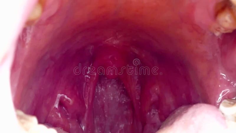 Tonsils deformed, tonsillitis, neglected poor human mouth interior, a child`s tonsils mouth inside and tonsillitis