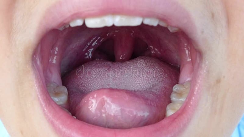 Tonsils deformed, tonsillitis, neglected poor human mouth interior