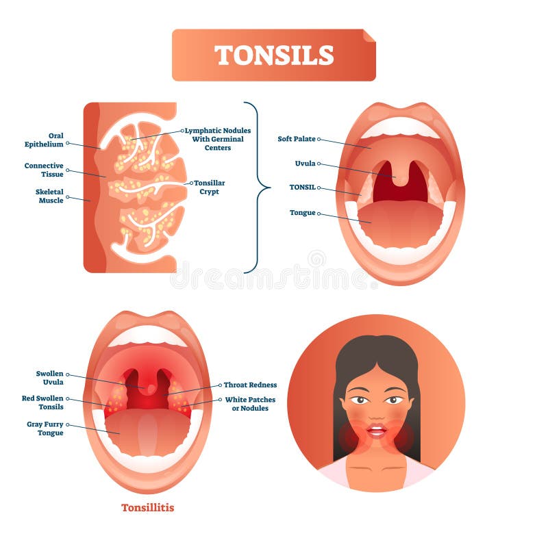 Tonsils wektoru ilustracja Tonsillitis przylepiający etykietkę struktura diagram ilustracji Tonsils wektoru ilustracja Tonsillitis przylepiający etykietkę struktura diagram ilustracji