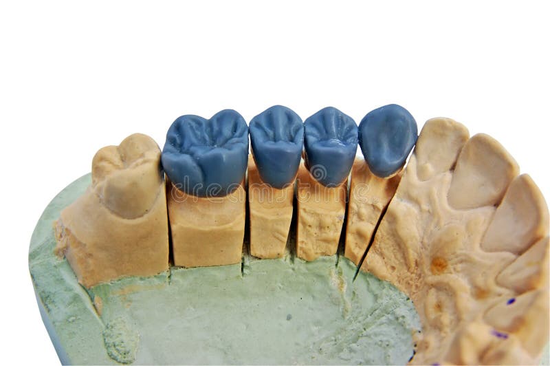 Dente della cera su un modello in gesso in una odontoiatria di laboratorio, isolato su bianco.