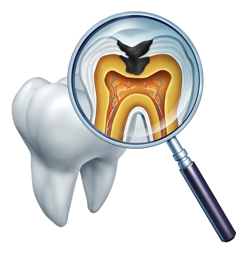 Diente cavidad de cerca caries desplegado vaso cruz sección de diente en rechazar gracias sobre el bacterias ácidos en cuidado desplegado podrido enfermedad gracias sobre el falta de de cepillado.