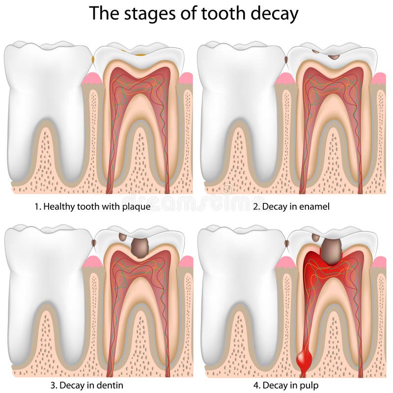 Stages of Tooth decay, eps8, gradient and mesh printing compatible. Normal cross vectors