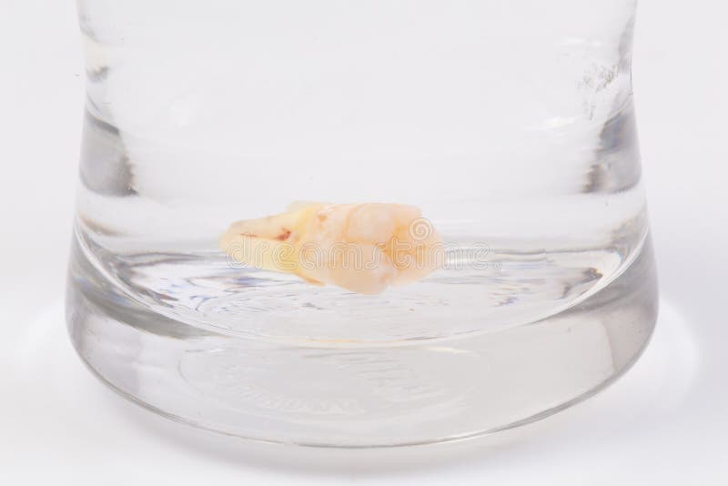 Tooth Decay in a Glass of Water Stock Photo Image of concept, dental