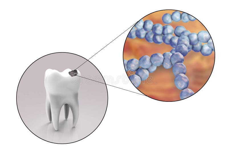 Dental Caries Clip Art