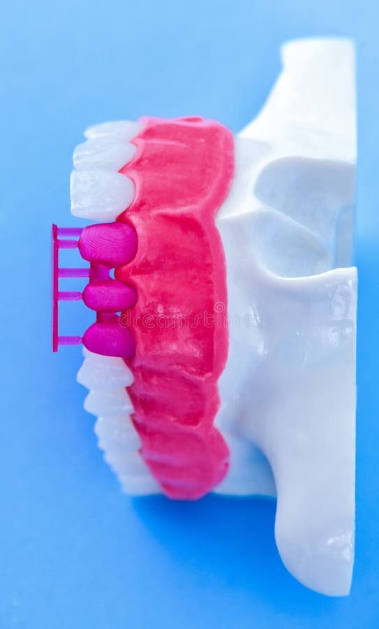 Tooth Implant and Crown Installation Process Stock Photo Image of