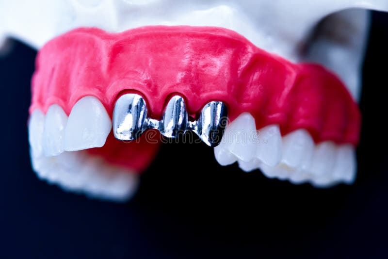 Tooth Implant and Crown Installation Process Stock Photo Image of