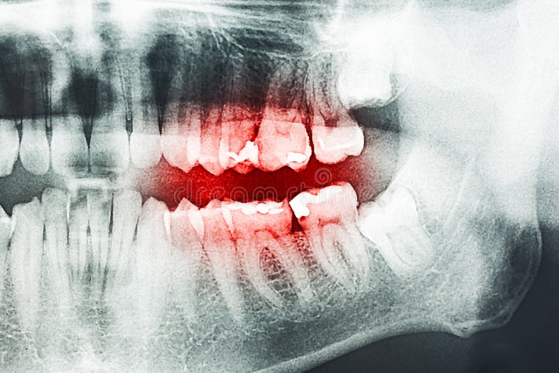 Tooth Pain on XRay stock photo. Image of head, health 46715332