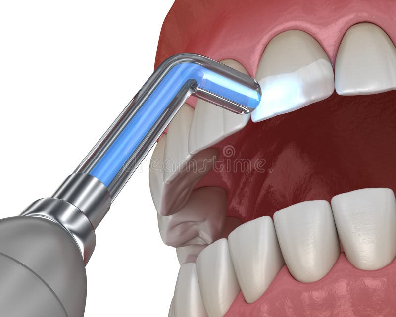 Tooth Restoration with Filling and Polymerization Lamp. Medically