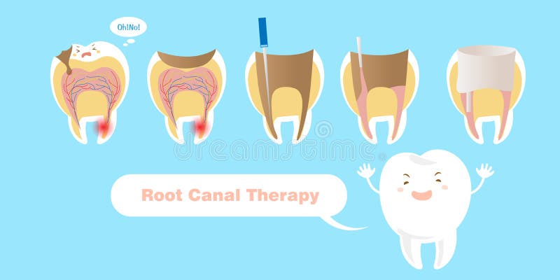 Cartoon Tooth Root Canal Treatment Stock Illustrations – 294 Cartoon Tooth Root Canal Treatment Stock Illustrations, Vectors & Clipart - Dreamstime Cartoon Tooth Root Canal Treatment Stock Illustrations – 294 Cartoon Tooth Root Canal Treatment Stock Illustrations, Vectors & Clipart - Dreamstime