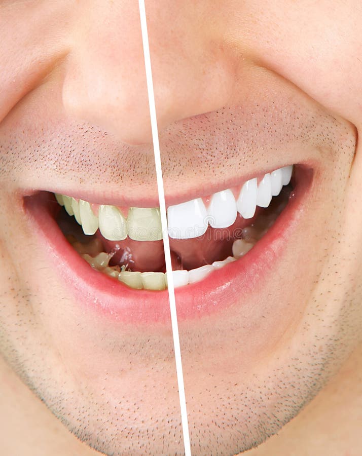 Male teeth before and after whitening. Male teeth before and after whitening