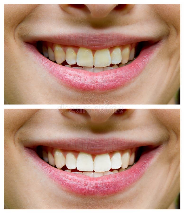 Dental bleaching effect before, after. Smiling woman mout teeth closeup. Dental bleaching effect before, after. Smiling woman mout teeth closeup.