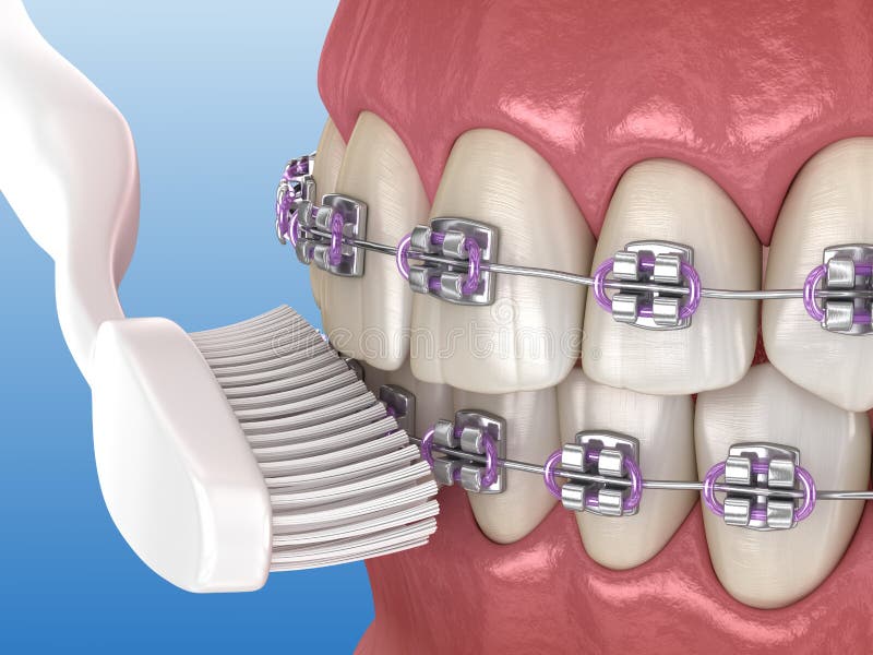 Toothbrush Cleaning Braces Process. Medically Accurate 3D Illustration