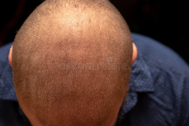 On head man without hair What Does
