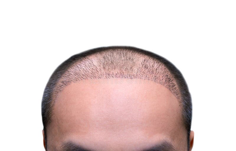 359 Top View Bald Head Stock Photos - Free & Royalty-Free Stock Photos from Dreamstime 359 Top View Bald Head Stock Photos - Free & Royalty-Free Stock Photos from Dreamstime
