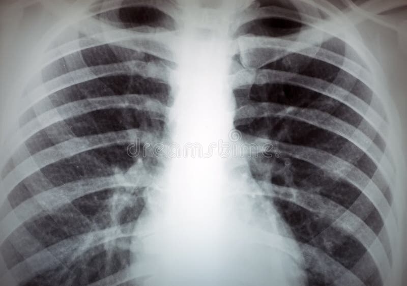 x-ray male thorax image. x-ray male thorax image