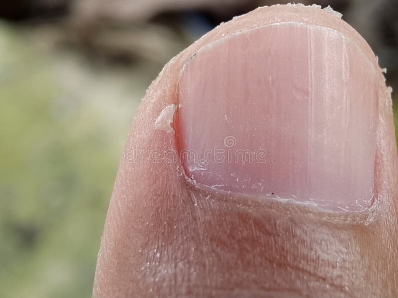 Torn Skin on the Side of the Nail. Stock Image Image of disease