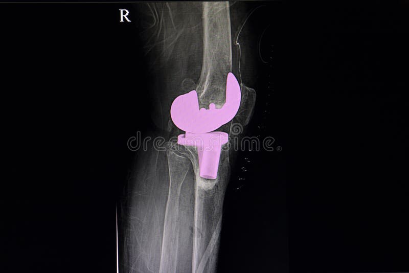 Total knee arthroplasty