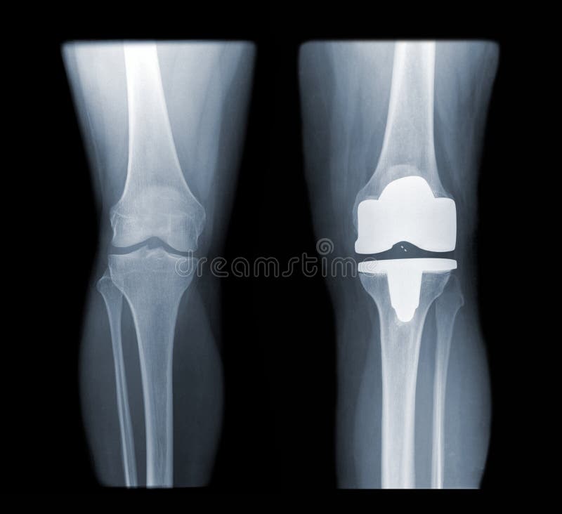 Image of two knees isolated on black background with a total knee replacement