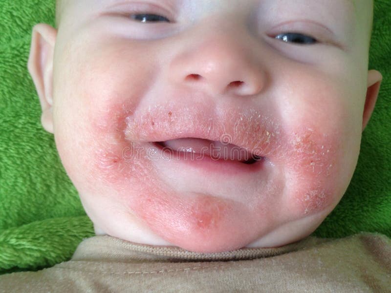 Allergie alimentaire eczéma
