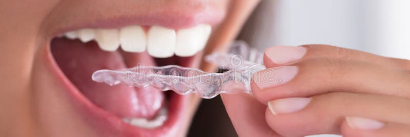 Traitement bruxiste. dents d'alignement dentaire orthodontique invisible photographie stock