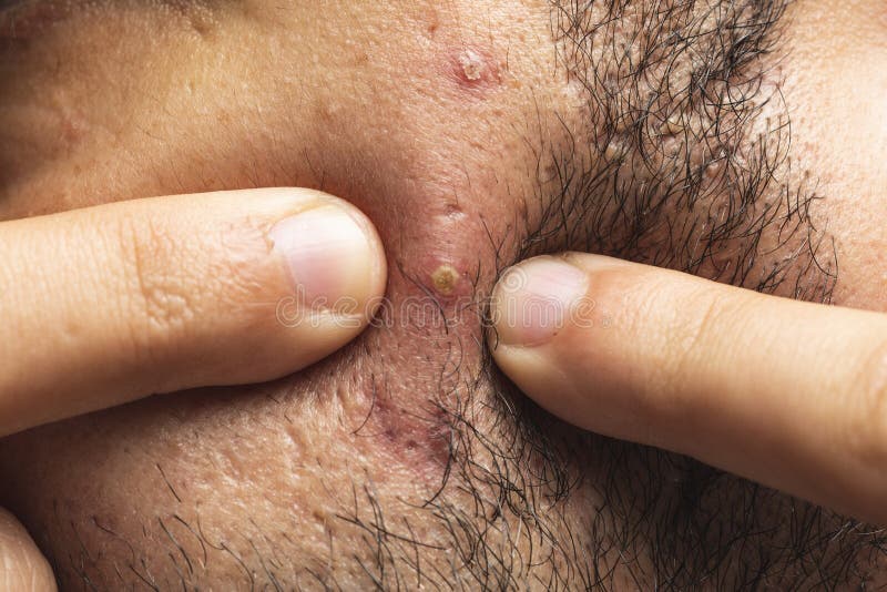 Traitement d'acné Homme d'acné serrant son bouton, enlevant le bouton de son visage Concept de soins de la peau d'homme Tache de