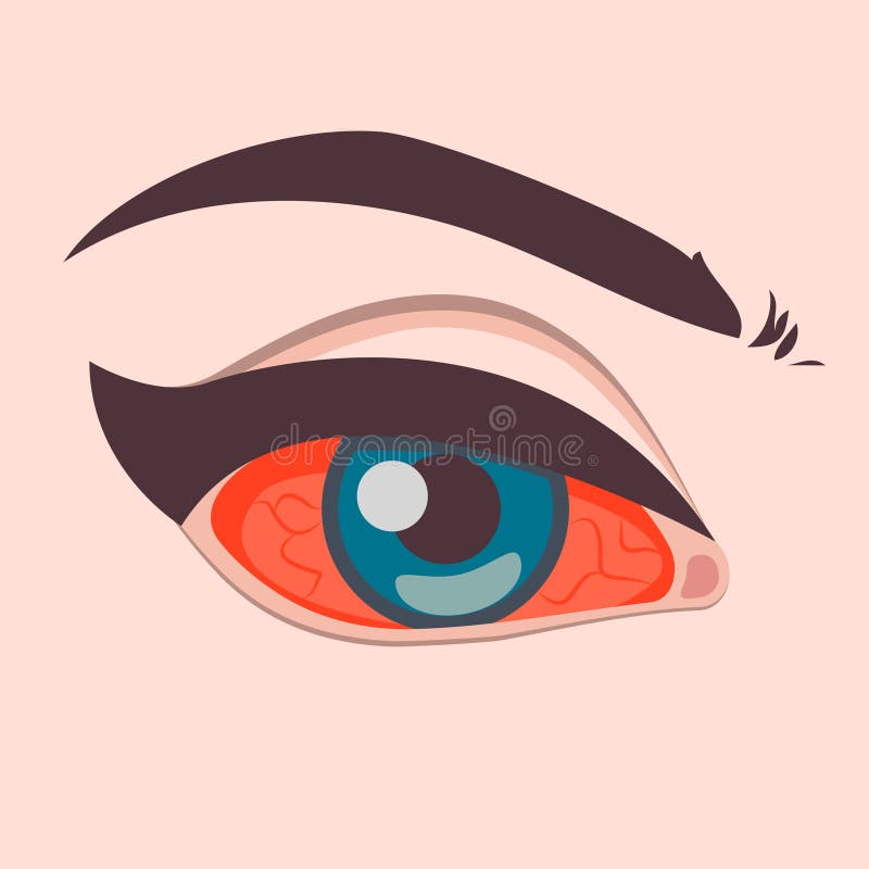 Trastorno De Los Ojos Dolor De Ojos Inflamación Ojos Enrojecidos Ojos Rojos Icono. Ilustración Vectorial Ilustración del Vector - Ilustración de dolorido, irritado: 240210908 Trastorno De Los Ojos Dolor De Ojos Inflamación Ojos Enrojecidos Ojos Rojos Icono. Ilustración Vectorial Ilustración del Vector - Ilustración de dolorido, irritado: 240210908