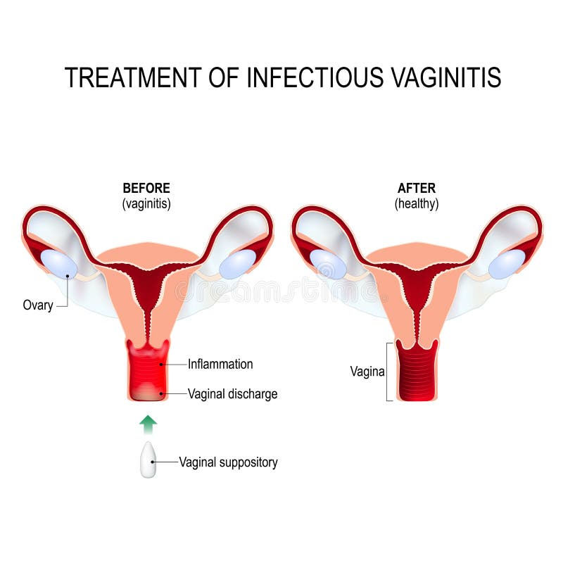 Tratamento de supositórios de vaginite. inflamação da vagina. Infográficos.  ilustração vetorial em fundo isolado imagem vetorial de mikrostoker©  136049596