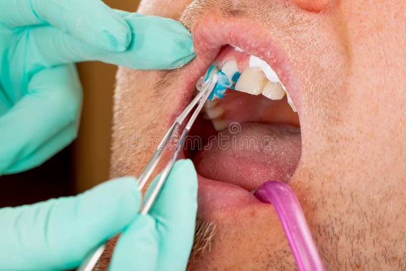 Tratamiento dental fotografía de archivo Tratamiento dental fotografía de archivo