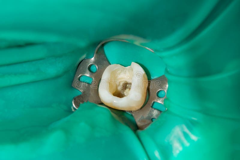 Tratamiento endodontic de la foto de canales dentales en la muela más baja p