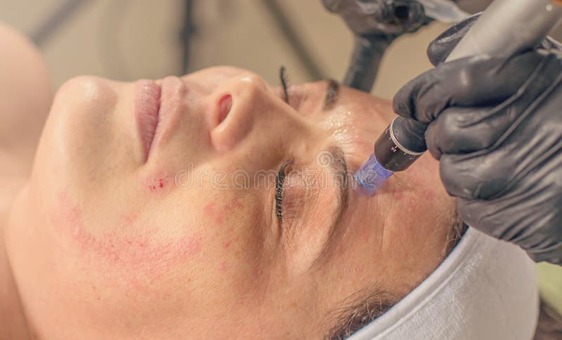 Tratamiento mesotherapy de la aguja en una cara de la mujer
