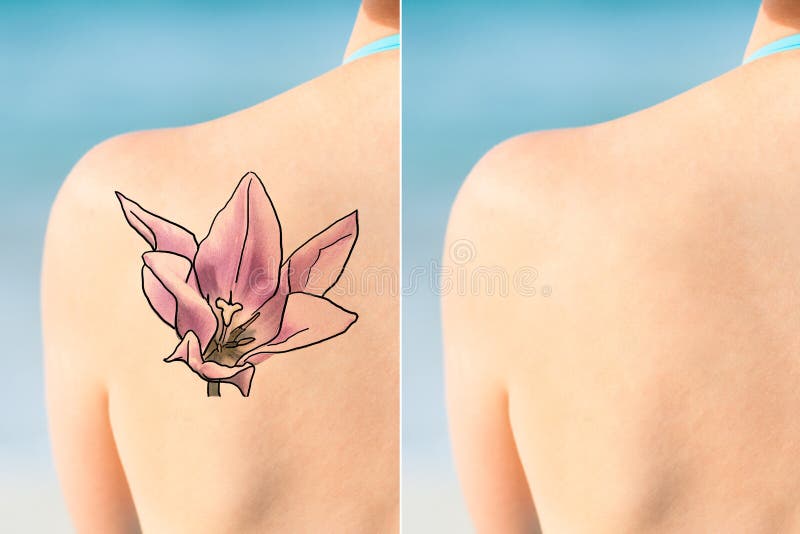 Trattamento di Person Showing Laser Tattoo Removal sulla spalla