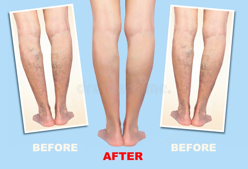 Trattamento di varicoso prima e dopo Vene varicose sulle gambe illustrazione vettoriale Trattamento di varicoso prima e dopo Vene varicose sulle gambe illustrazione vettoriale