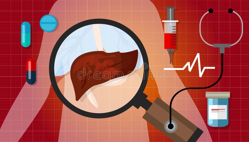 Trattamento non sano malato di anatomia umana dell'illustrazione di malattia del cancro del fegato medico illustrazione vettoriale Trattamento non sano malato di anatomia umana dell'illustrazione di malattia del cancro del fegato medico illustrazione vettoriale