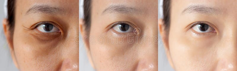 Tre bilder j?mf?rde behandling f?r effekt f?re och efter under ögon med problem av mörka cirklar, puffiness och skrynklor royaltyfri bild Tre bilder j?mf?rde behandling f?r effekt f?re och efter under ögon med problem av mörka cirklar, puffiness och skrynklor royaltyfri bild