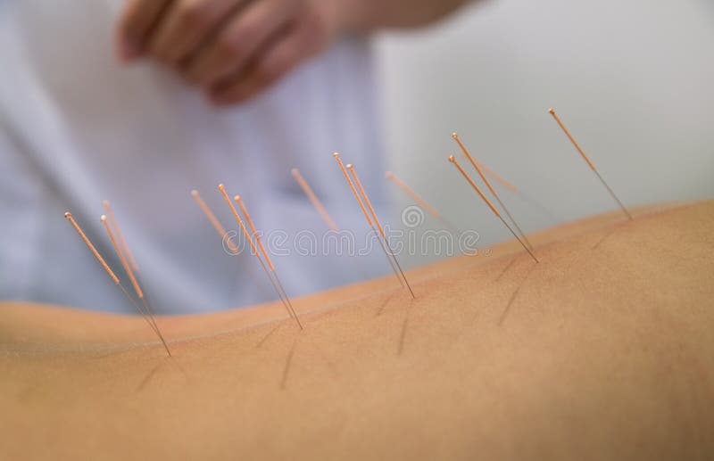 Treatment by acupuncture stock photo. Image of wellbeing 57017830