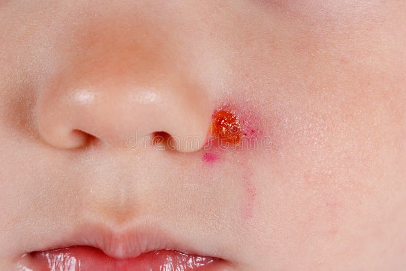 Treatment and Prevention of Insect Bites Stock Image Image of acne