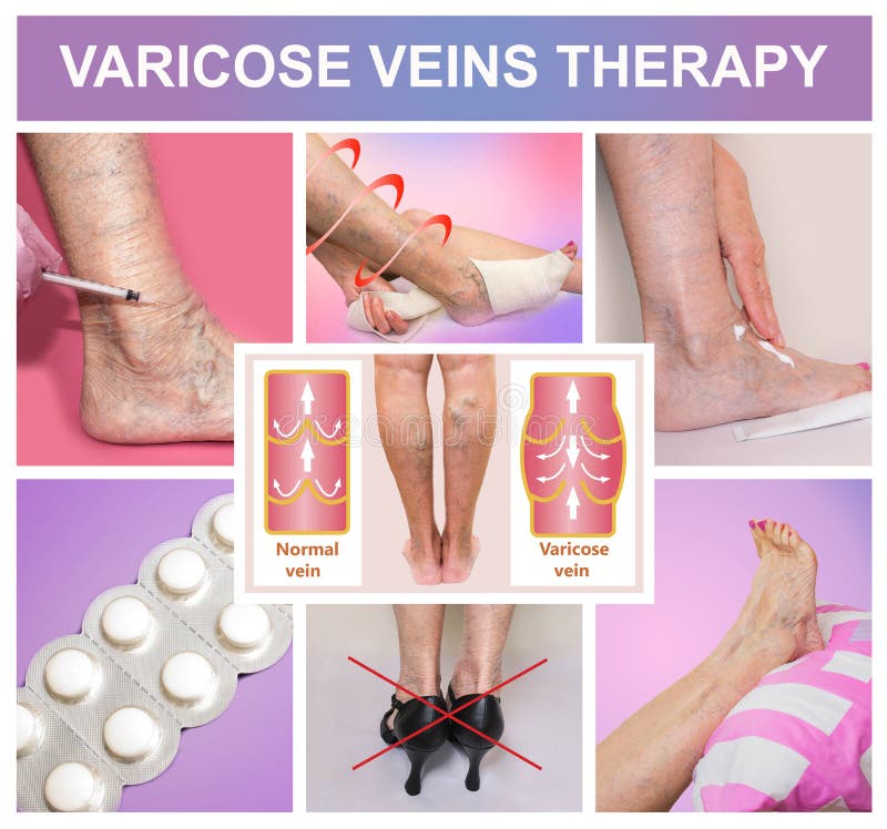 Treatment of Varicose Veins Stock Photo Image of health, pressure