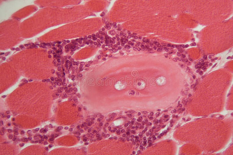 Trichinella spiralis larvae in muscle tissue under the microscope.