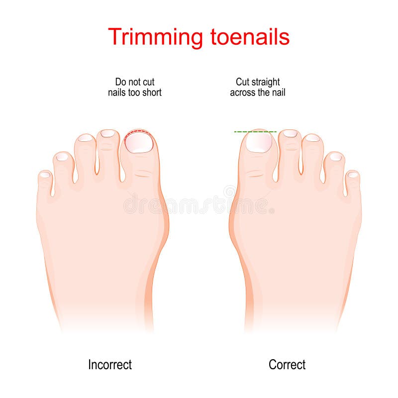 Trimming Toenails. Incorrect and Correct Stock Vector - Illustration of  nails, beauty: 248674451