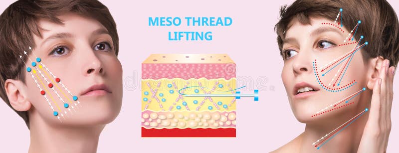 Meso thread Lift. Young female with clean fresh skin. Beautiful woman. face and neck. Lifting by threads concept. Meso thread Lift. Young female with clean fresh skin. Beautiful woman. face and neck. Lifting by threads concept