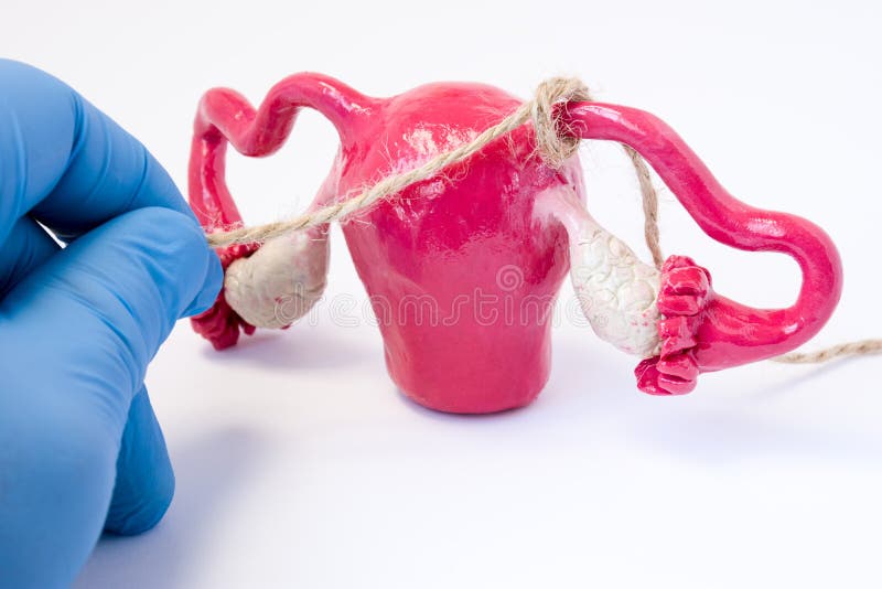 Tubal ligation or surgical procedure tubectomy in operative gynecology concept photo. Doctor binds with rope fallopian tubes model of female genital organs uterus and ovaries. Surgical sterilization