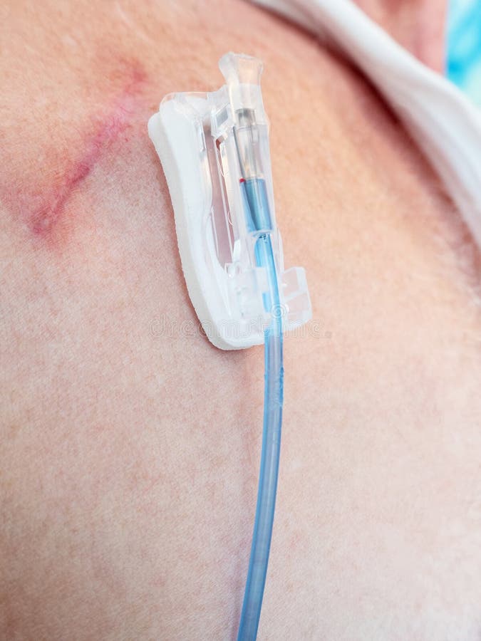 Tube for intravenous fluids injections to implantable port for chemotherapy  Stock Photo