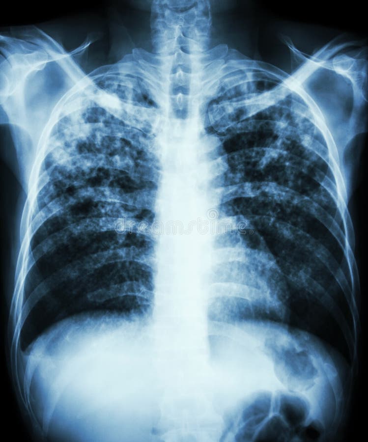 Tuberculose pulmonaire photographie stock Tuberculose pulmonaire photographie stock
